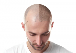 Hair Transplant In Iran Affordable Hair Transplant Cost Medipars